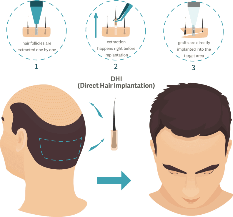 Dhi Haartransplantation