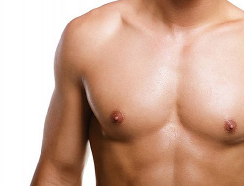 Gynecomastia