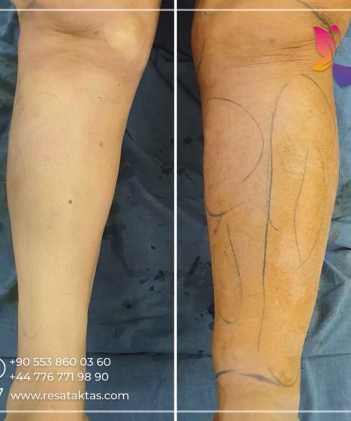 lipedema surgery turkey