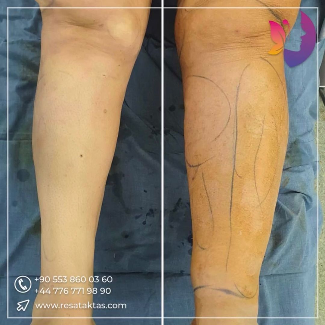 https://www.resataktas.com/en/wp-content/uploads/2020/10/lipedema-surgery-turkey.jpg