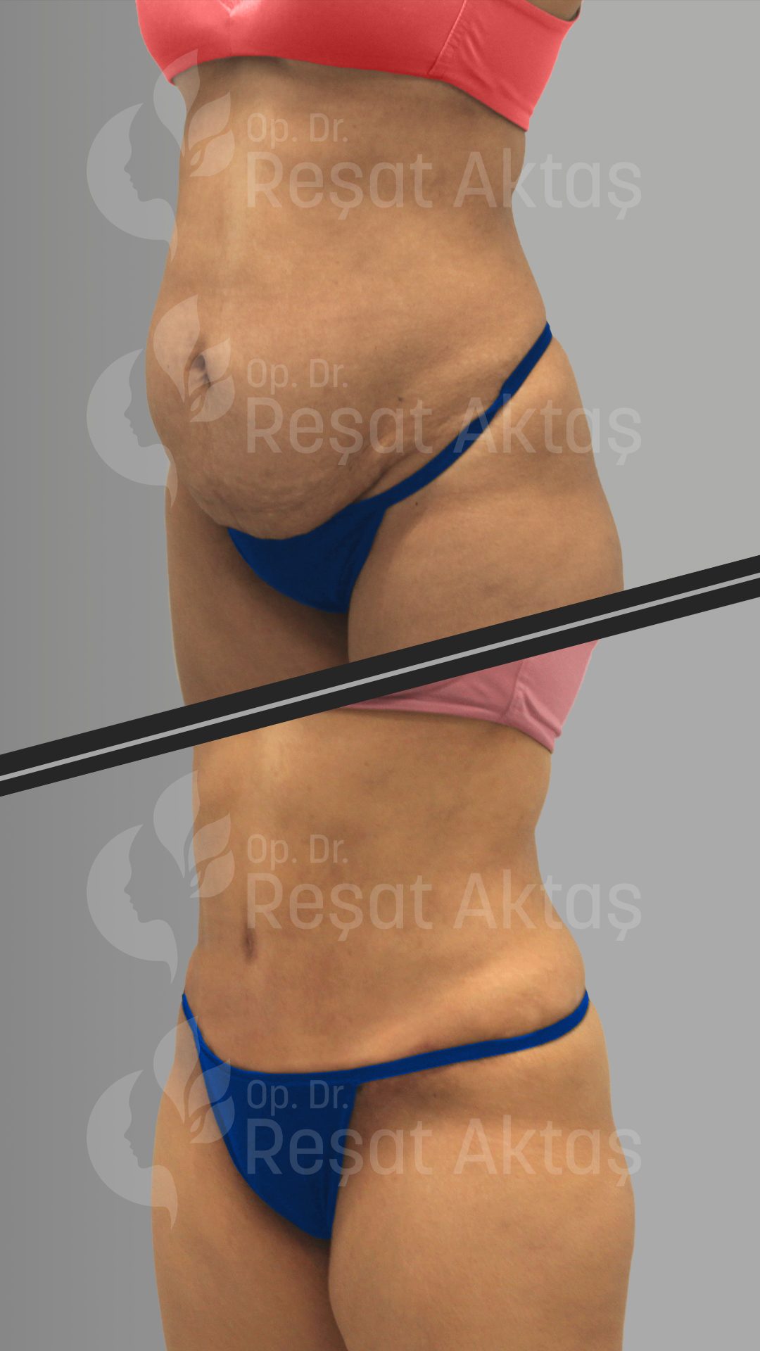 tummy tuck surgery