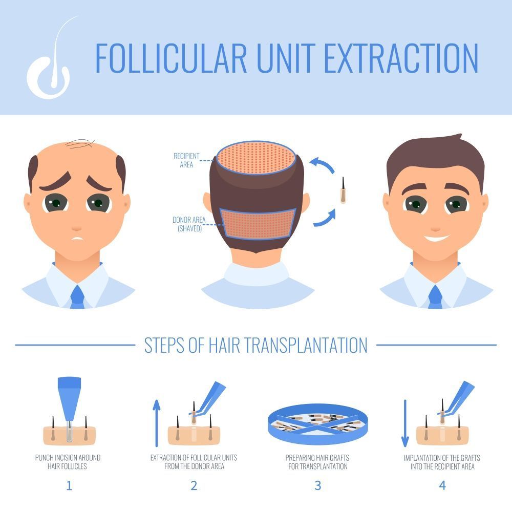 FUE Hair Transplant Procedure