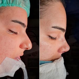 burun estetiği türkiye