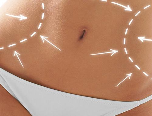 karın germe ameliyatı 2