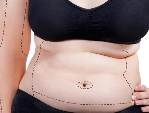 obezite cerrahisi sonrası estetik