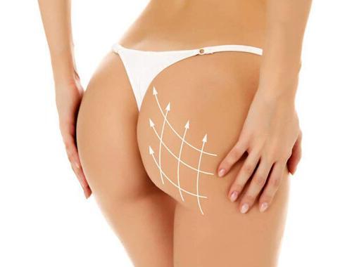 kalça büyütme estetiği 1