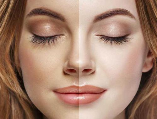 revizyon burun ameliyatı